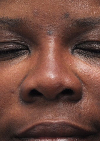 Non Surgical Rhinoplasty after 407865