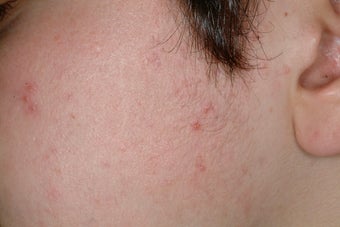 Laser Acne Treatment after 86809