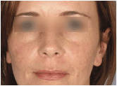 active fx fractional resurfacing after 267554
