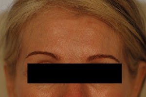 Coreecting Asymmetry with Botox (Dysport Browlift). before 649422