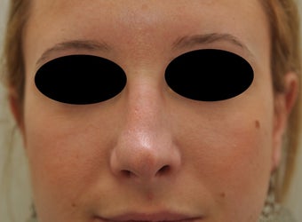 Non-surgical rhinoplasty before 182425
