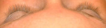 Latisse treatments for eyelashes before 105271