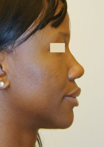 African-American Rhinoplasty after 104227