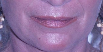 Lip Augmentation before 203774