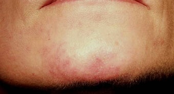 Vascular malformations or birthmarks after 136698