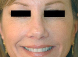 Botox for Crows Feet after 93348