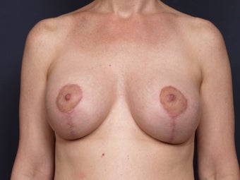 Breast Lift after 140829