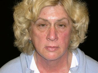 Face lift,brow lift, eyelid lift, fat injections face-volume replacement before 251754