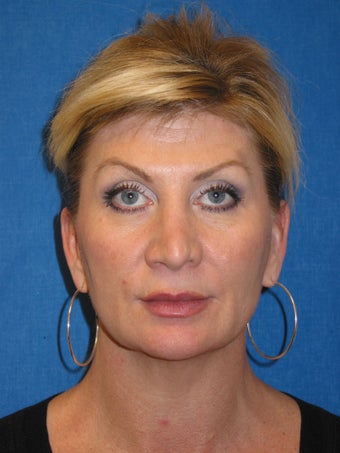 Ultherapy after 613752