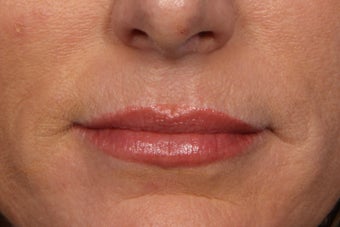 Botox after 309235