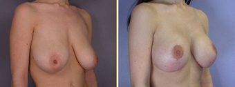 Mastopexy, Breast Lift before 270059