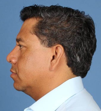 Rhinoplasty, Nasal Fracture Repair 539992