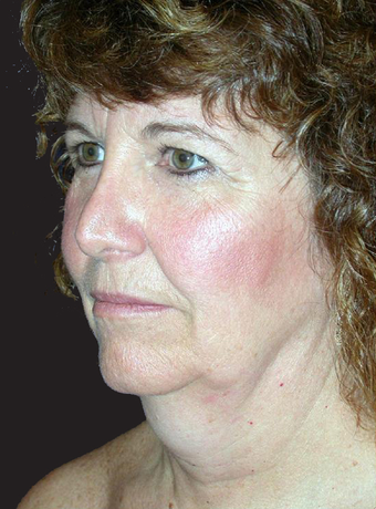 Neck Lift before 229648