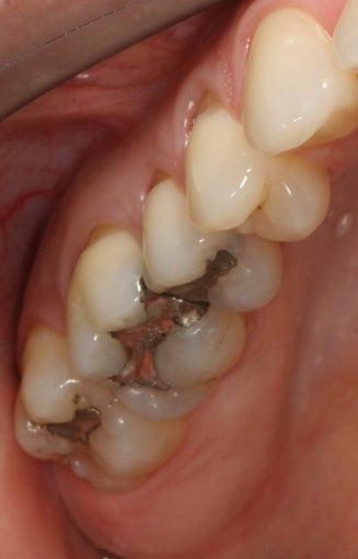 Replacing Old Silver Fillings With Porcelain Fillings before 94812