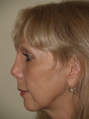 Revision rhinoplasty before 172859