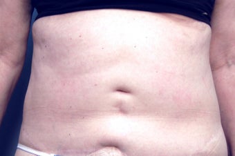 Slim Lipo before 137503
