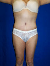 Tummy Tuck Surgery (abdominoplasty) after 129744