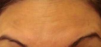 botox injections before 263054