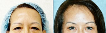 Endoscopic Brow Lift by Wave Plastic Surgery & Dermatology Center before 649404