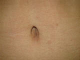 Belly Buttons after Tummy Tuck Surgery after 133865