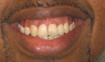 Braces: correction of openbite and dental crowding after 346378