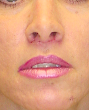 Lip Lift after 635441