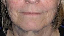 "Liquid face lift" before 374978