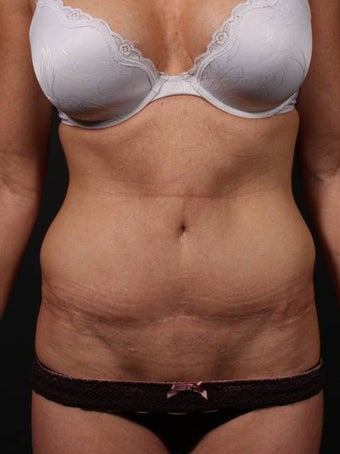 Full tummy tuck revision before 356434