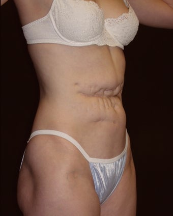 Abdominoplasty before 226266