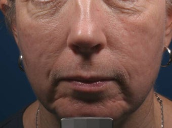 Fraxel - acne scars after 136193