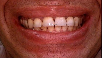 Full Porcelain Crowns before 145680