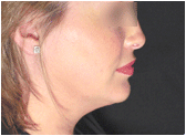chin lipo with platysmal plication (mini necklift) after 267585