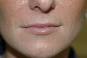 Lip augmentation before 340189