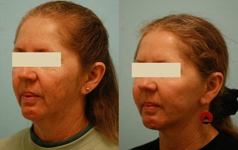 Otoplasty (Cosmetic Ear Pinning) before 136389