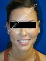 Ear Surgery (Otoplasty) 616517