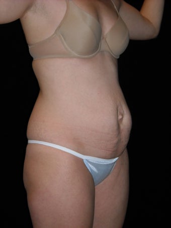 Tummy tuck (abdominoplasty) before 222560
