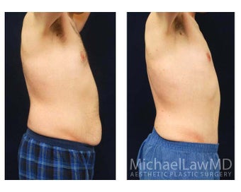 Abdominoplasty - Tummy Tuck 396130