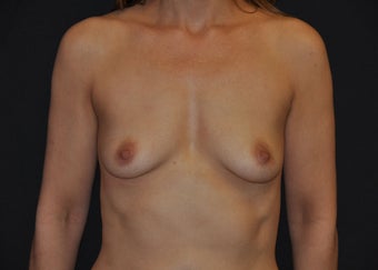 Bilateral "dual plane" breast augmentation before 481485