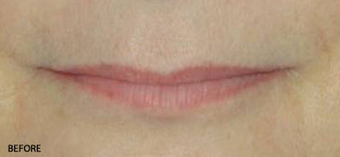 Juvederm - Upper and Lower Lip before 328108