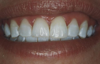 Teeth Whitening after 485396