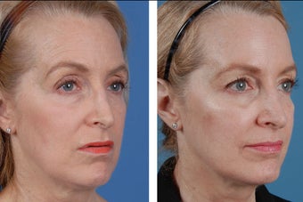 Restylane and Botox Cosmetic 356495