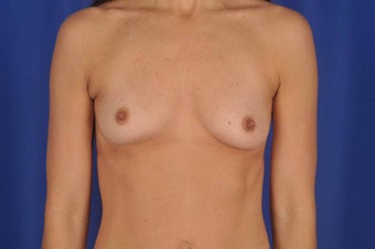 39 year-old woman desired breast implants before 634063