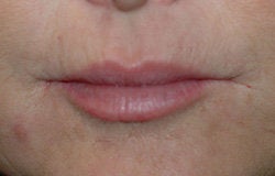 Restylane injections for upper lip lines before 91656