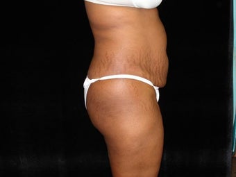 Standard Abdominoplasty before 203400