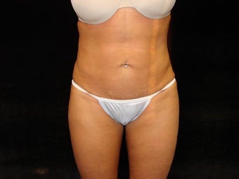 Liposuction of Abdomen, Waist, Flanks, and Inner/Outer Thighs after 203475