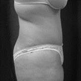 Tummy Tuck, Liposuction 402480