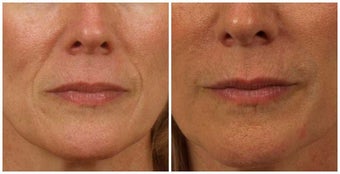 Restylane before 336764