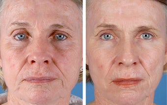Active FX Fractional Laser Resurfacing before 253993