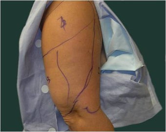 Liposuction of the arms before 589893