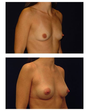 Breast Augmentation before 149520